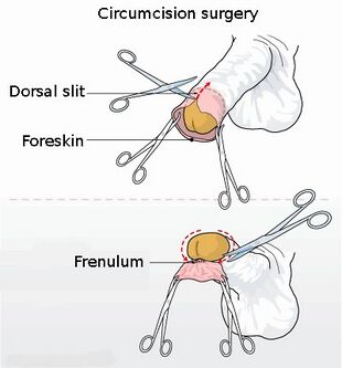 Circumcision illustration.jpg