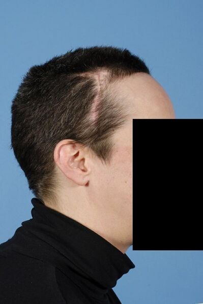 File:Forehead bulk defect picture 4.jpg