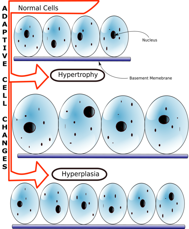 medicine-hyperplasia-handwiki