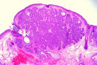 Trichoepithelioma (1338537528).jpg