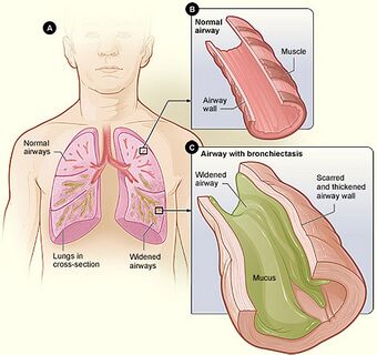 Bronchiectasis NHLBI.jpg