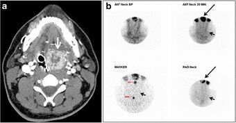 CT and scintigraphy of lingular ectopic thyroid.jpg