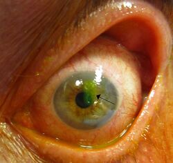 Human cornea with abrasion highlighted by fluorescein staining.jpg