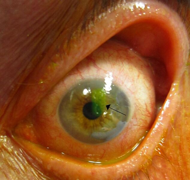 File:Human cornea with abrasion highlighted by fluorescein staining.jpg