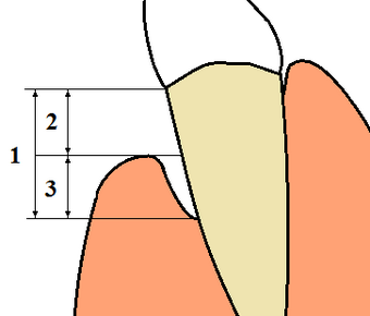 Periodontal terms diagram gingival recession.png