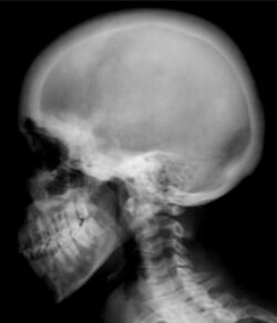 X-ray of ground glass density of the skull by renal osteodystrophy.jpg