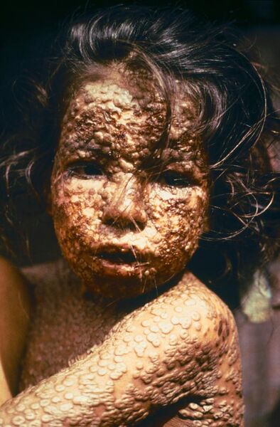 File:Child with Smallpox Bangladesh.jpg