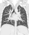 Coronal maximum intensity projection CT thorax.gif