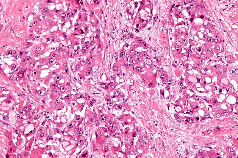 File:Fibrolamellar hepatocellular carcinoma -2- high mag.jpg