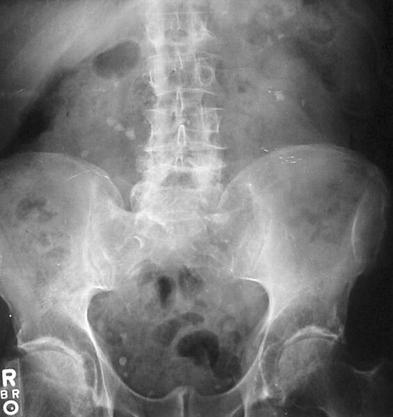 File:Kidney stones abdominal X-ray.jpg
