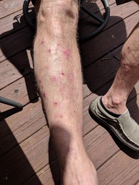 File:Legs Bullous Pemphigoid.jpg