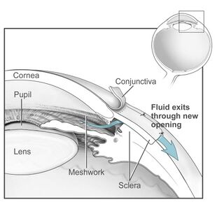 Conventional surgery to treat glaucoma EDA11.JPG