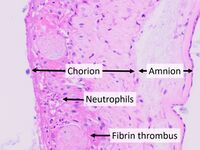 Histopathology of chorioamnionitis.jpg