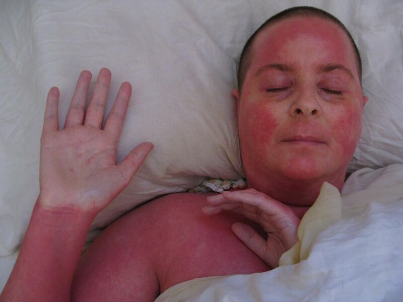 File:Red (burning) Skin Syndrome - Showing Face Pattern with white nose sign and spared palms (soles spared too).jpg