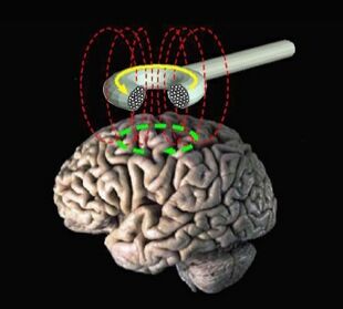 Transcranial magnetic stimulation.jpg