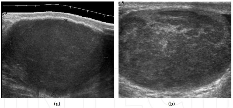 File:Ultrasound images of seminomas.jpg