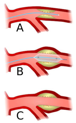Angioplasty-scheme.svg