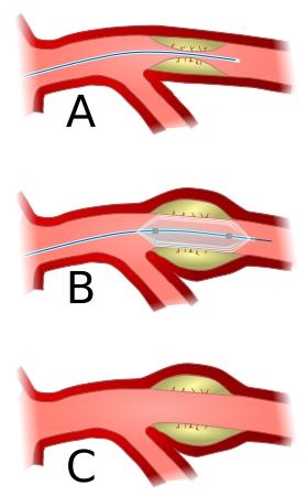 File:Angioplasty-scheme.svg