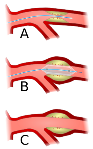 Angioplasty-scheme.svg