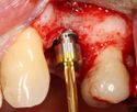 A healing abutment is attached to the implant fixture and the gingiva flap is sutured around the healing abutment.