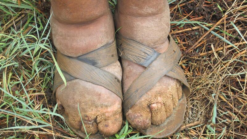 File:Ethiopian Farmer affected by Podoconiosis - NIH - March 2011.jpg