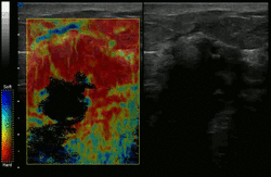 Manual compression elastography of invazive ductal carcinoma 00132.gif