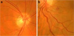 Retinal vessel tortuosity.jpg