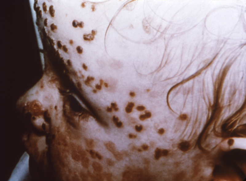 File:Modified smallpox2.png