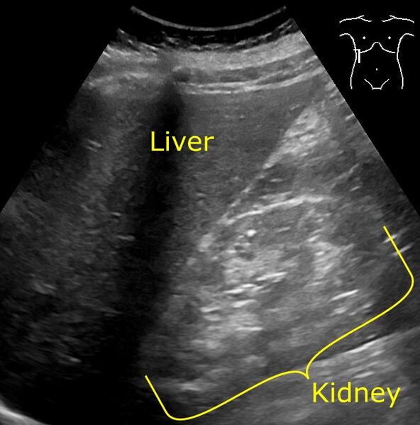File:Ultrasonography of kidney with diabetic nephropathy - annotated.jpg