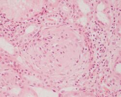 Crescentic glomerulonephritis HE stain.JPEG