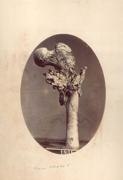 File:Gunshot Fracture of the Left Femur 1863.jpg