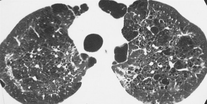 File:HRCT of cysts of pneumocystis pneumonia.jpg