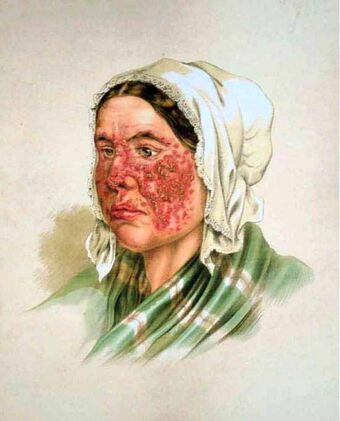 Lupus erythematosus, Atlas der Hautkrankheiten.jpg