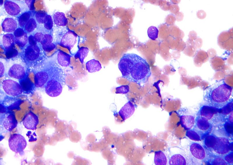 File:Melanoma - cytology field stain.jpg