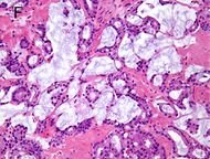 Micrograph of mucinous adenocarcinoma of the prostate with Gleason score 7 (3 + 4) with individual well-formed glands and minor component of cribriform glands floating in extracellular mucin.jpg