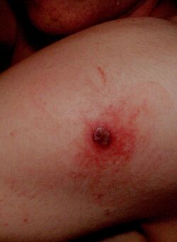 Smallpox vaccine site.jpg