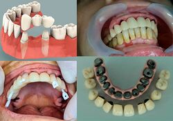 Dental prosthesis.jpg