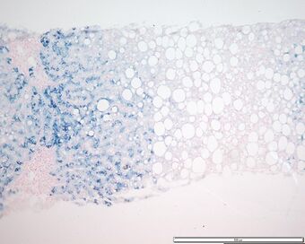 Hemochromatosis liver iron prussian blue.jpg