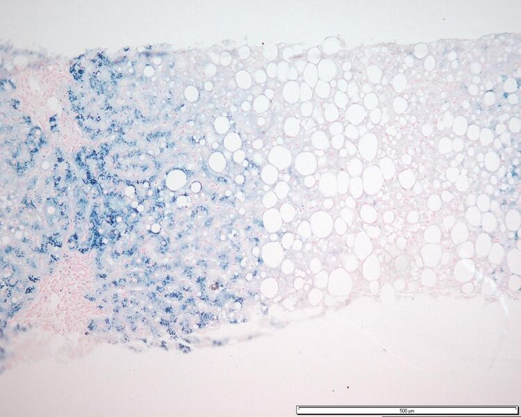 File:Hemochromatosis liver iron prussian blue.jpg