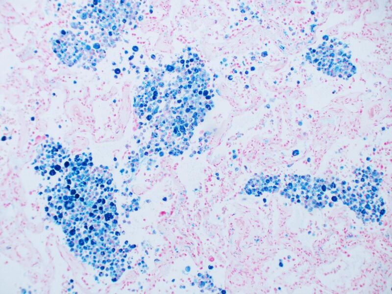 File:Intra-alveolar hemosiderin deposition - Prussian blue stain.jpg