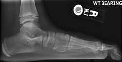 Lateral X-ray of a flat foot an C-sign.jpg