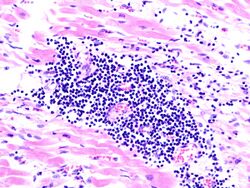 Viral myocarditis (1).JPG