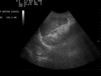 Ultrasound image of spleen 110314102702 1031200.jpg
