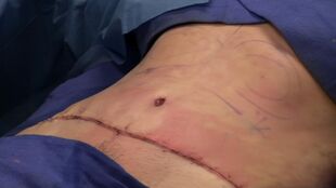 Abdominoplasty completely sutured.jpg