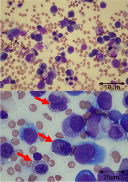 Bone marrow smear with May Grünwald–Giemsa staining.png