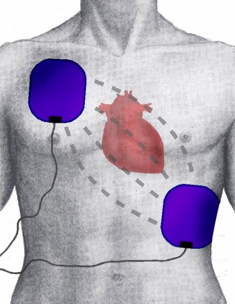 File:Defibrillation Electrode Position.jpg