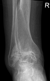 Frontal X-ray scan of ankle with secondary osteoarthritis