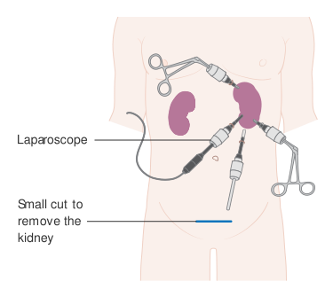 File:Diagram showing laparoscopic surgery for kidney cancer CRUK 165.svg