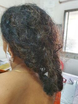 Hair matting after few sessions of chemotherapy.jpg
