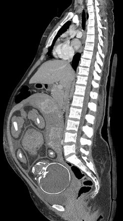 Median plane CT scan of a pregnancy of 37 weeks of gestational age.jpg
